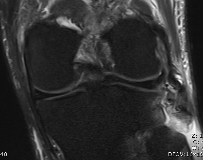 MRI LCL and Biceps Fibular Avulsion